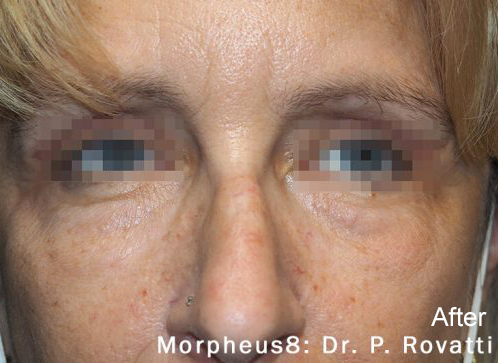 after morpheus under eye treatment artistry of face