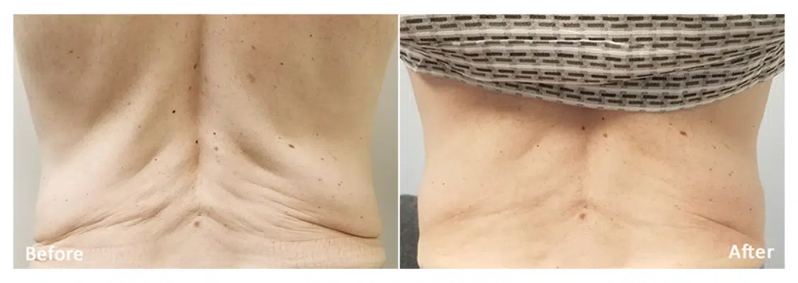 before and after morpheus treatment on back at artistry of face