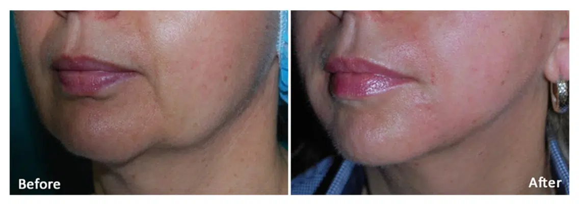 before and after morpheus treatment on face at artistry of face