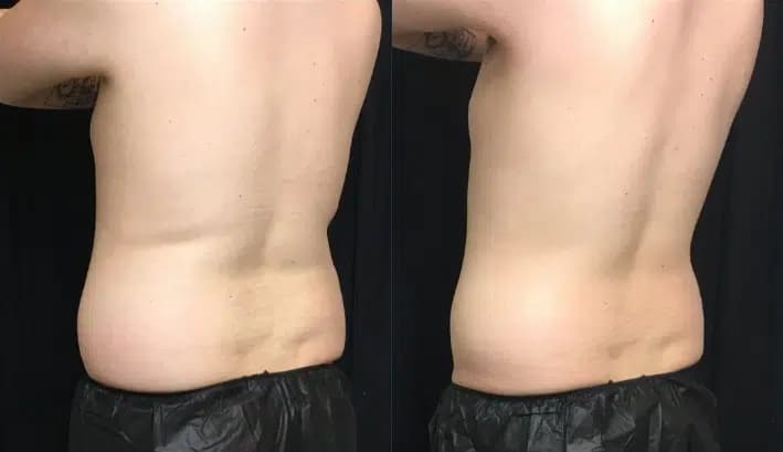 CoolSculpting before and after photo by The Artistry of Face in Albany, NY