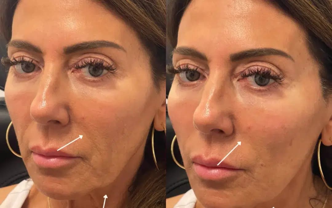 Cheek Filler before and after photo by The Artistry of Face in Albany, NY