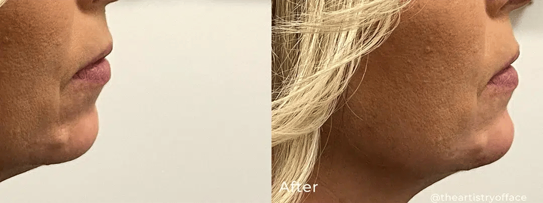 Chin Filler before and after photo by The Artistry of Face in Albany, NY
