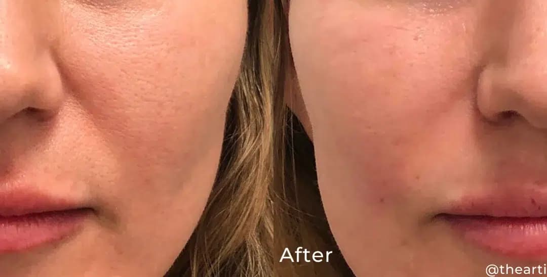 Nasolabial filler before and after photo by The Artistry of Face in Albany, NY