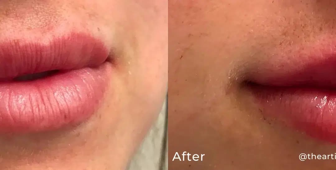 Lip filler before and after photo by The Artistry of Face in Albany, NY