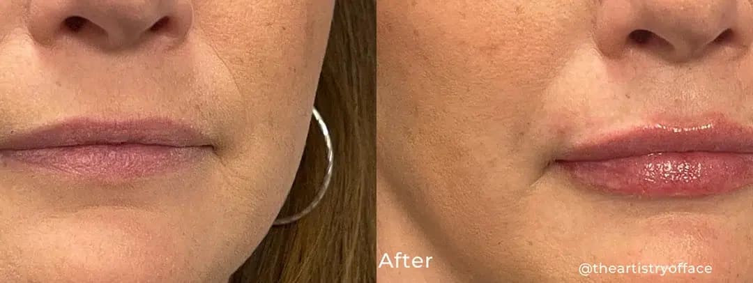 Lip flip before and after photo by The Artistry of Face in Albany, NY