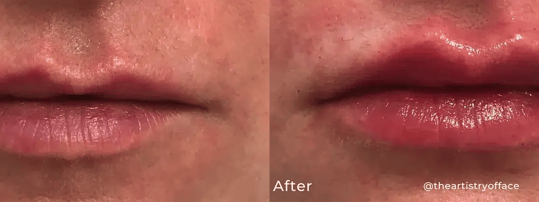 Lip filler before and after photo by The Artistry of Face in Albany, NY