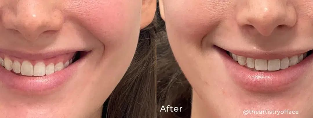 Lip flip before and after photo by The Artistry of Face in Albany, NY