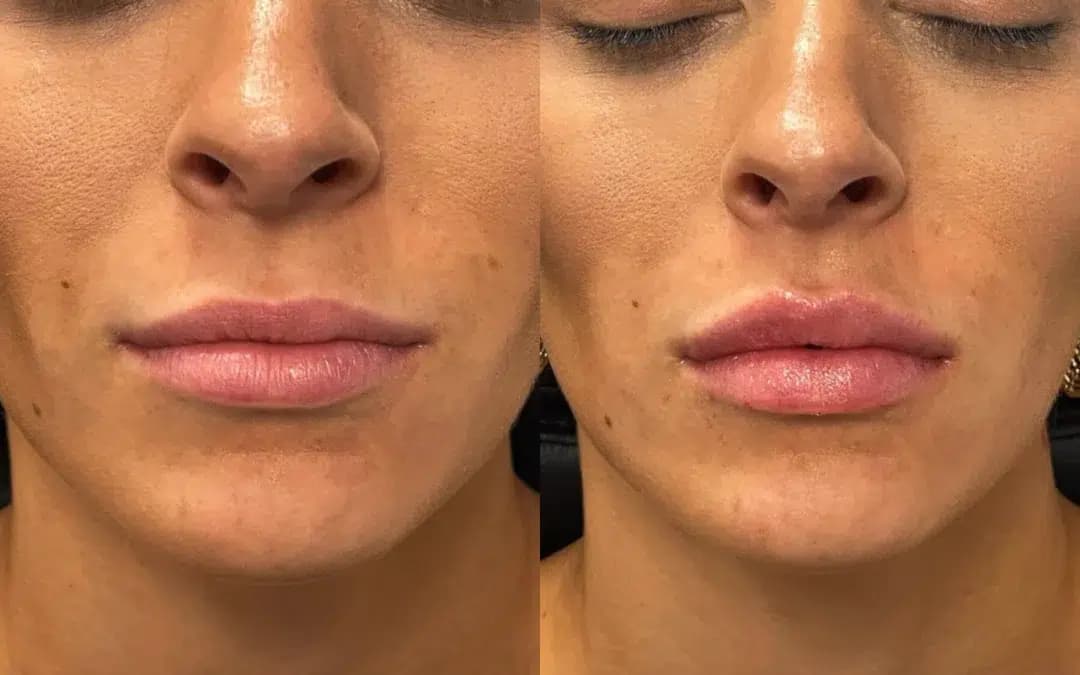 Lip filler before and after photo by The Artistry of Face in Albany, NY