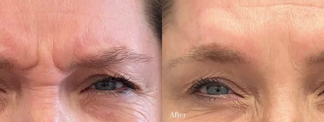 Glabella Botox before and after photo by The Artistry of Face in Albany, NY