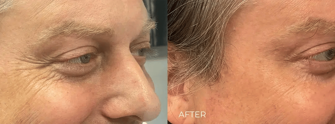 Dysport before and after photo by The Artistry of Face in Albany, NY