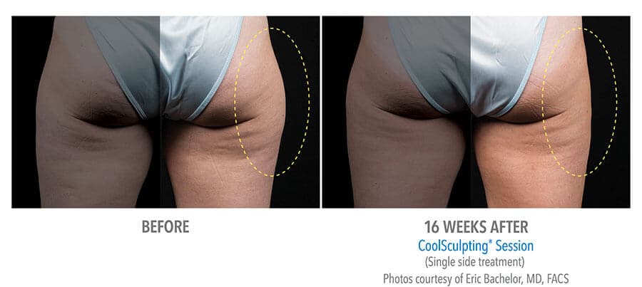 artistry of face coolsculpting before after albany ny artistry of face coolsculpting before after albany ny