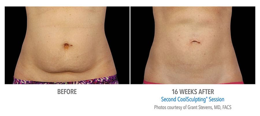 artistry of face coolsculpting before after albany ny artistry of face coolsculpting before after albany ny