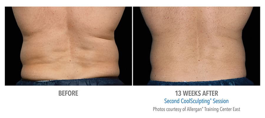 artistry of face coolsculpting before after albany ny artistry of face coolsculpting before after albany ny