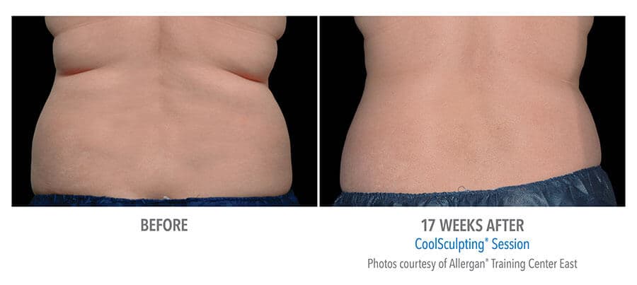artistry of face coolsculpting before after albany ny artistry of face coolsculpting before after albany ny