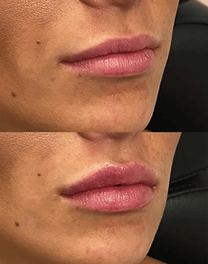 cheek filler before and after photo by the artistry of face in albany ny x cheek filler before and after photo by the artistry of face in albany ny x
