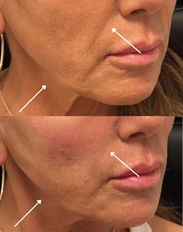 cheek filler before and after photo by the artistry of face in albany ny x cheek filler before and after photo by the artistry of face in albany ny x