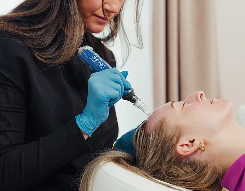 Practitioner in blue gloves using a SkinPen Precision Elite device on a female patient's hairline.