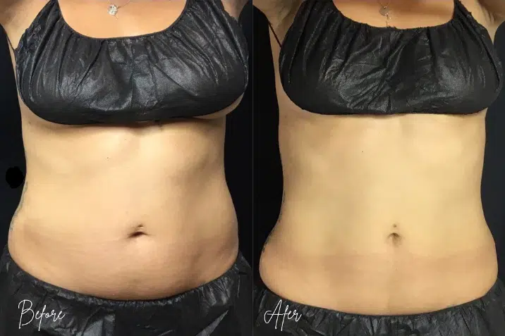 CoolSculpting before and after photo by The Artistry of Face in Albany, NY