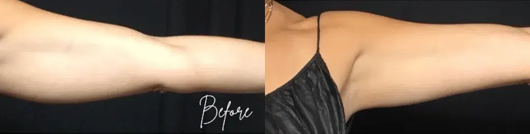 CoolSculpting before and after photo by The Artistry of Face in Albany, NY