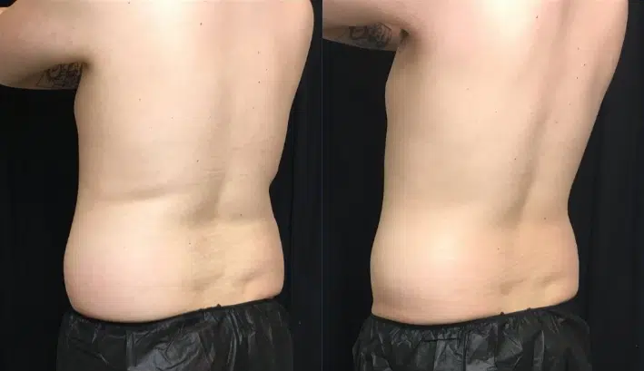 CoolSculpting before and after photo by The Artistry of Face in Albany, NY