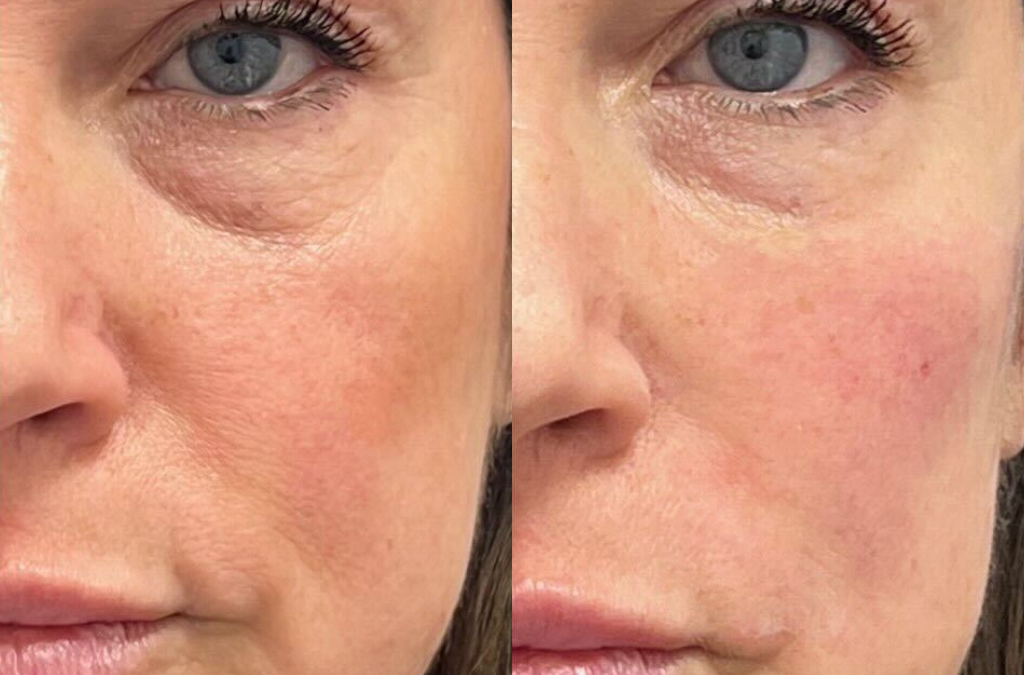 Cheek Filler before and after photo by The Artistry of Face in Albany, NY