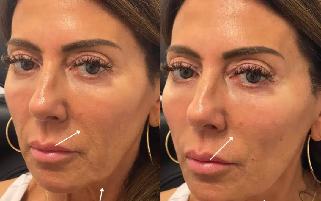 Cheek Filler before and after photo by The Artistry of Face in Albany, NY