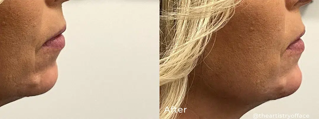 Chin Filler before and after photo by The Artistry of Face in Albany, NY