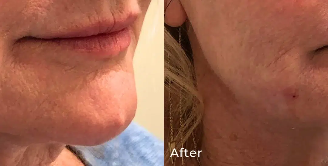 Jaw Filler before and after photo by The Artistry of Face in Albany, NY