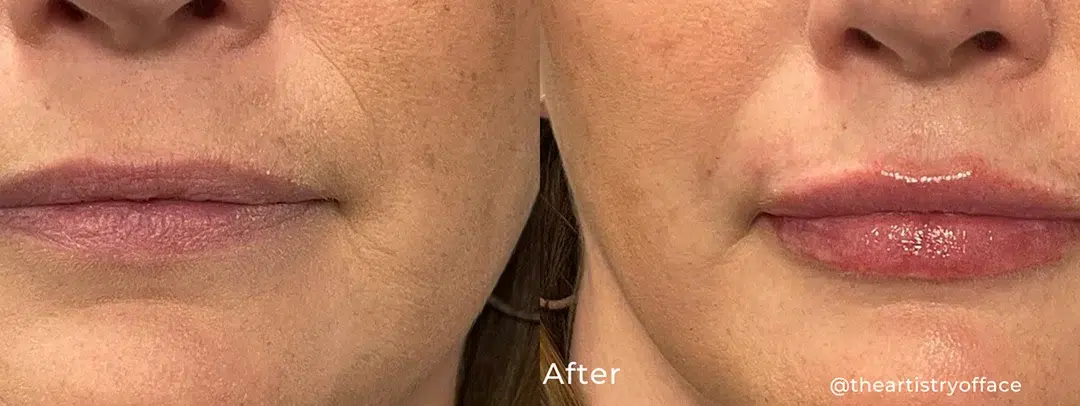 Lip flip before and after photo by The Artistry of Face in Albany, NY