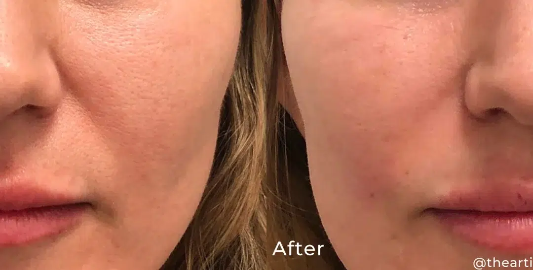 Nasolabial filler before and after photo by The Artistry of Face in Albany, NY