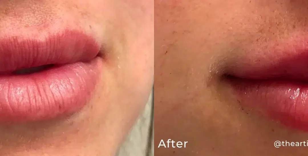 Lip filler before and after photo by The Artistry of Face in Albany, NY