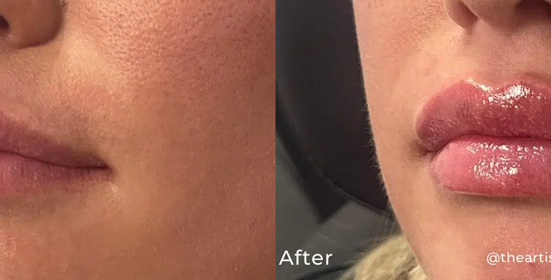 Lip filler before and after photo by The Artistry of Face in Albany, NY