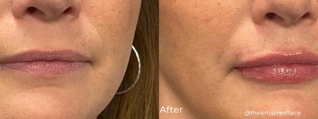 Lip flip before and after photo by The Artistry of Face in Albany, NY