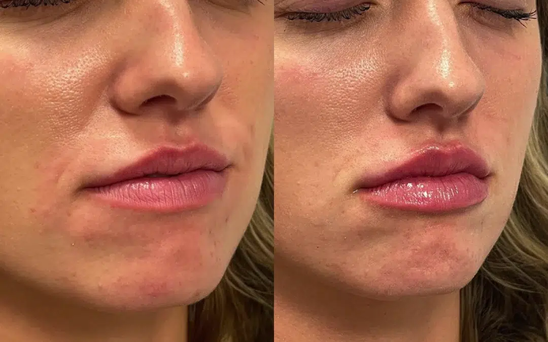 Lip filler before and after photo by The Artistry of Face in Albany, NY