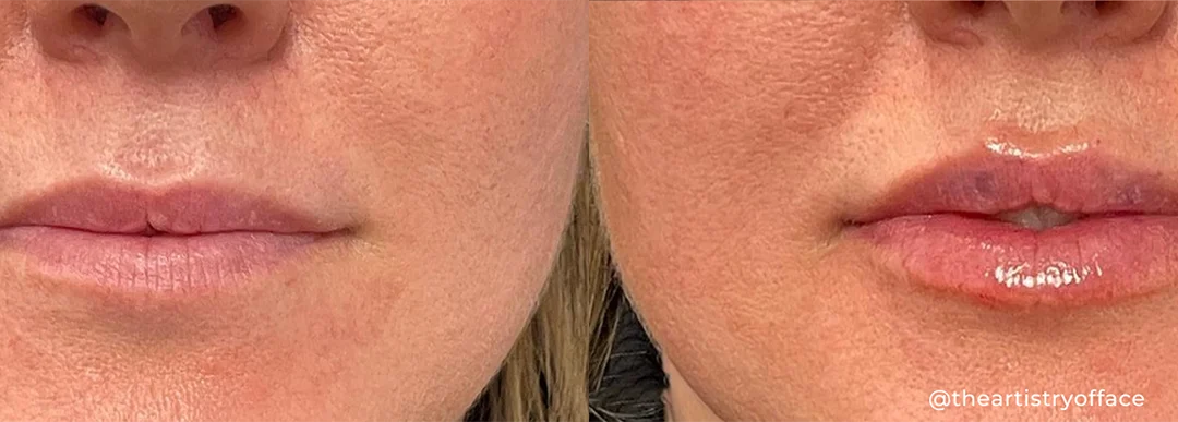 Lip filler before and after photo by The Artistry of Face in Albany, NY