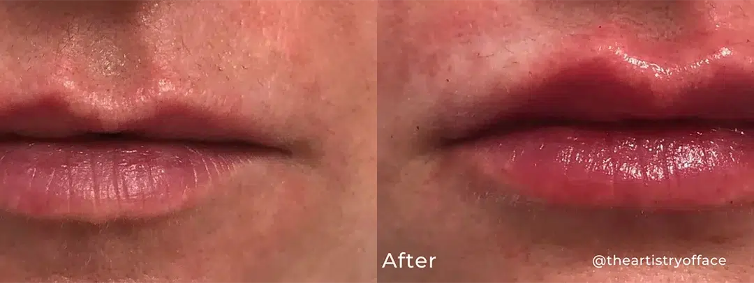 Lip filler before and after photo by The Artistry of Face in Albany, NY