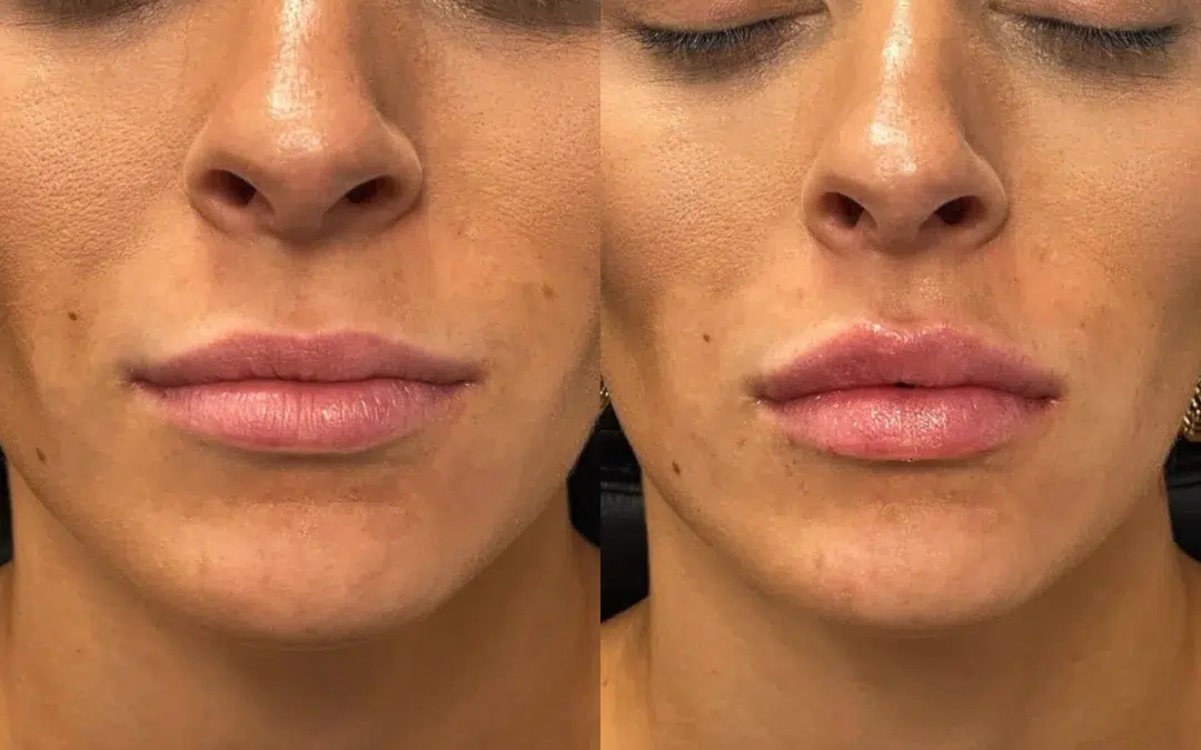Lip filler before and after photo by The Artistry of Face in Albany, NY