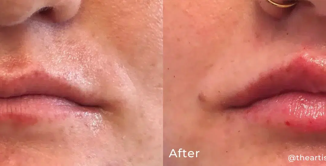 Lip filler before and after photo by The Artistry of Face in Albany, NY