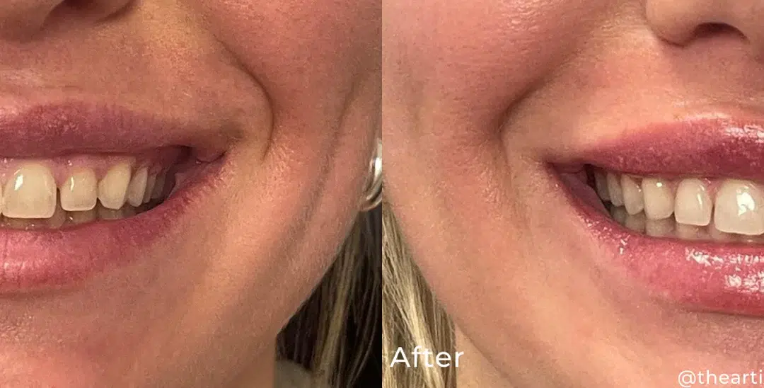 Lip filler before and after photo by The Artistry of Face in Albany, NY