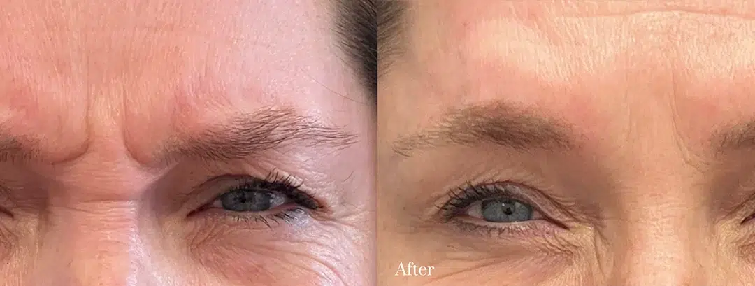 Glabella Botox before and after photo by The Artistry of Face in Albany, NY