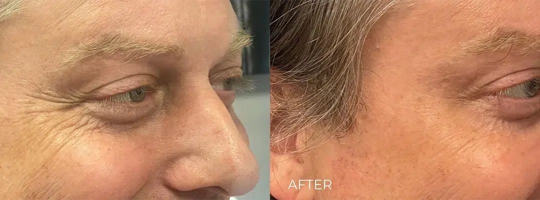 Dysport before and after photo by The Artistry of Face in Albany, NY