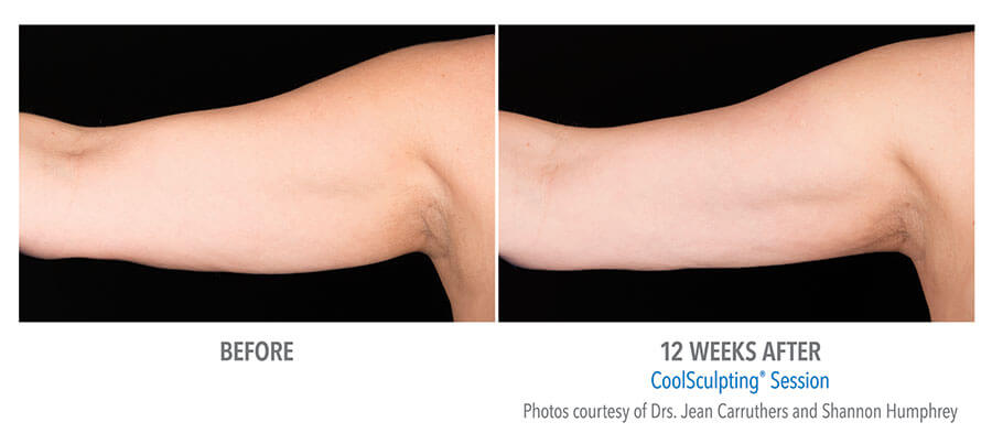 artistry of face coolsculpting before after albany ny