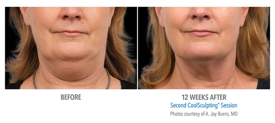 artistry of face coolsculpting before after albany ny