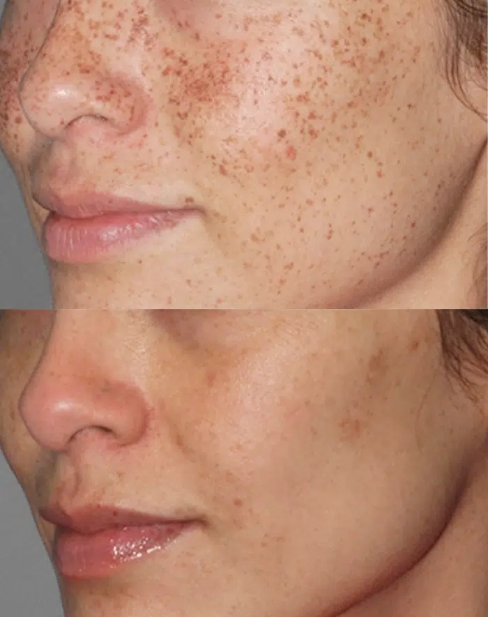 before and after lumecca treatment on face at artistry of face